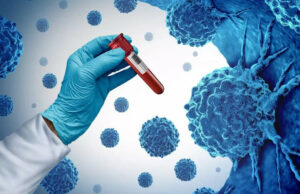 Los casos de cáncer aumentan entre los jóvenes; cambios simples en el estilo de vida para reducir el riesgo