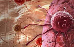 Los datos del mundo real revelan beneficios de supervivencia de las resecciones anatómicas para el cáncer de pulmón en etapa temprana