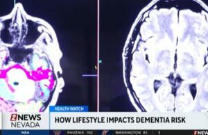 Health Watch: Impacto del estilo de vida en el riesgo de demencia