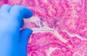 El aprendizaje automático revela por qué los ensayos sobre el cáncer fracasan en pacientes del mundo real