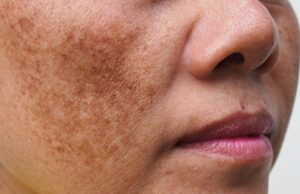 El consumo de alcohol y otros factores de estilo de vida pueden contribuir a la melasma