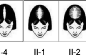 Factores de dieta y estilo de vida poco saludable vinculados a la alopecia androgenética femenina: un estudio comunitario del estudio Jidong, China | Salud pública de BMC