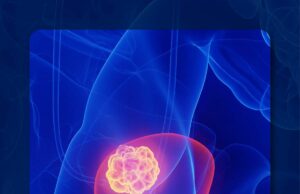 Los datos del mundo real muestran una vedotina de Enfortumab mejorando significativamente el sistema operativo en el carcinoma urotelial