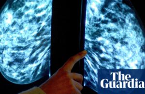NHS para lanzar el mayor ensayo mundial de diagnóstico de cáncer de mama de IA | Cáncer de mama