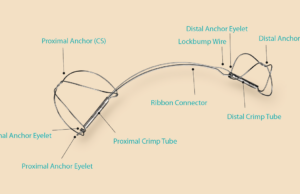 Resultados positivos con el dispositivo Mitral Carillon Vistado en registros del mundo real