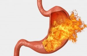 Dieta, hacks de estilo de vida para despedirse del reflujo ácido y protegerse del cáncer de teesofágico | Salud