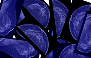 Una de cada 20 mujeres en todo el mundo diagnosticadas con cáncer de seno