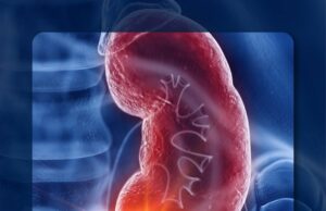 Los datos del mundo real admiten el uso de primera línea de Avelumab más axitinib en RCC avanzado