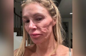 Brandi Glanville de Real Housewives of Beverly Hills pide ayuda después de que 'Face se derrita' del parásito inexplicable 'comer'