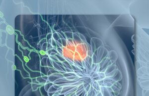 El combo de Palbociclib de primera línea mejora los resultados en la población de cáncer de mama HR+/HER2 negativo de HER2 de áreas desfavorecidas