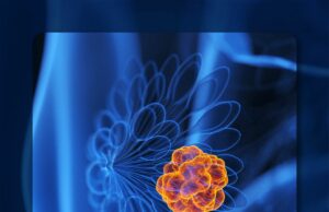 Sacituzumab Govitecan mantiene la eficacia y la seguridad en la población de MTNBC del mundo real