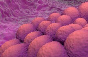 El análisis del mundo real confirma la eficacia/seguridad de dostarlimab más quimioterapia en cáncer de endometrio avanzado