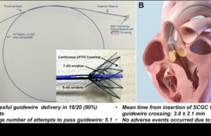 Los cardiólogos son los primeros en usar el nuevo catéter TAVR de Boston Scientific