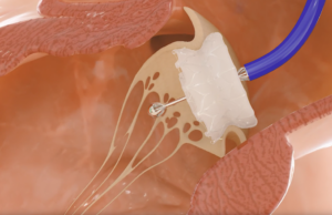 Los cardiólogos hacen historia, los primeros reemplazos de la válvula mitral del transcatéter robótico del mundo