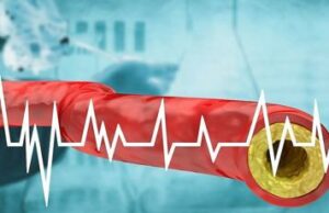 El sistema de calificación puede evitar una cirugía innecesaria para las arterias obstruidas