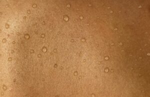 La importancia de los controles de la piel regulares para la prevención del cáncer